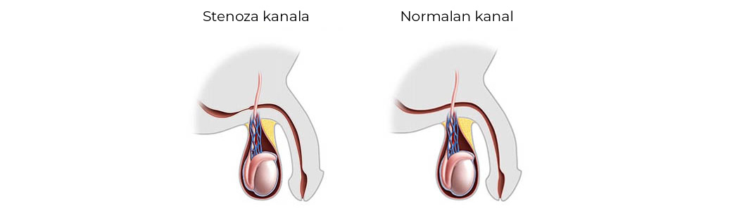 stenoza uretrei