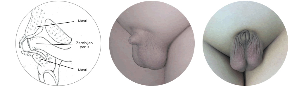 Zarobljen (trapped) penis kod dece