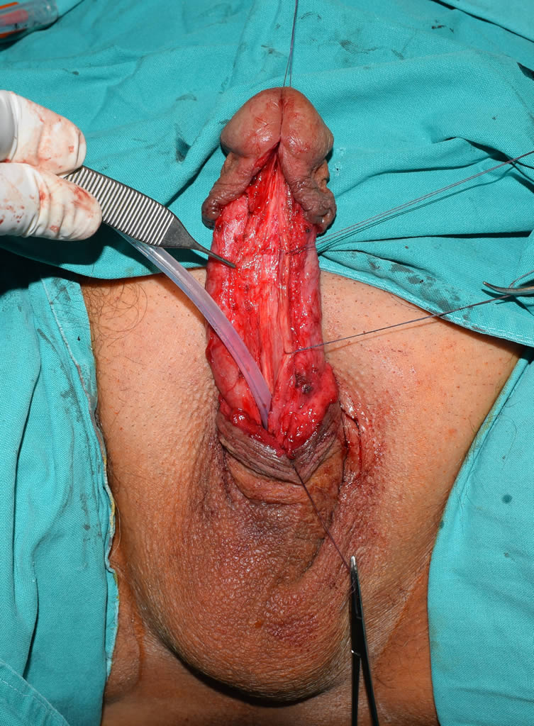 The narrowed part of the urethra is opened