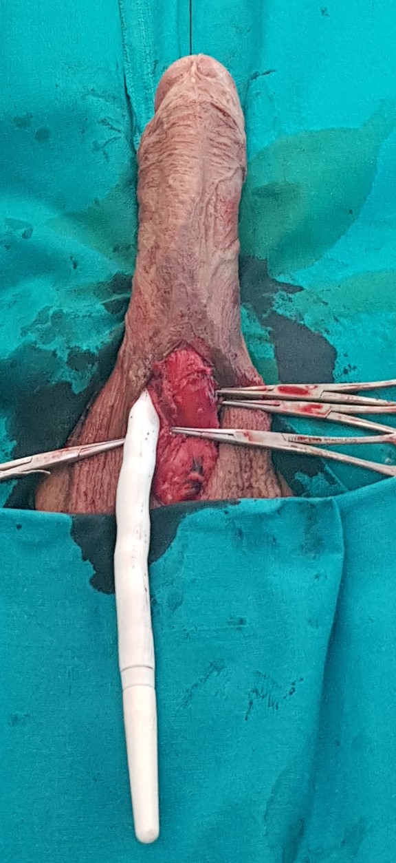 Implantation of the right rod