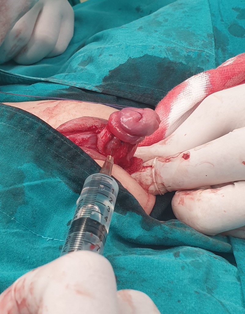 Hipospadija operativne slike - Ispravljena krivina penisa