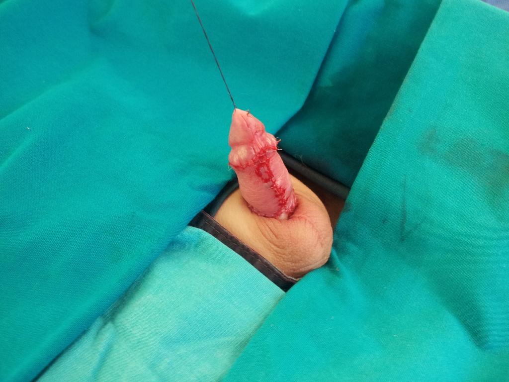 Ukopan penis operativna slika - Stanje nakon korekcije