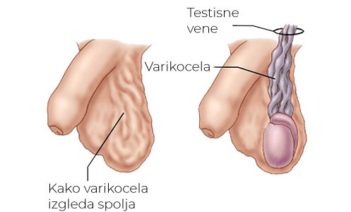 Varikocela