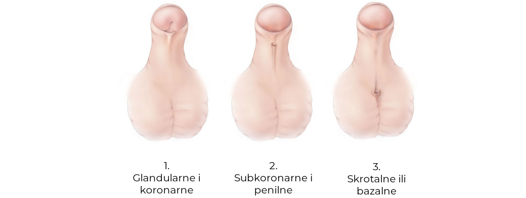 Tipovi hipospadije kod dece
