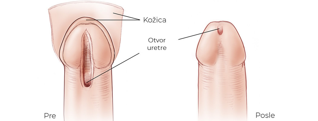 Hipospadija kod dece vrste
