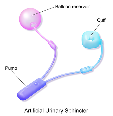 Incontinence, artificial sphincter 2