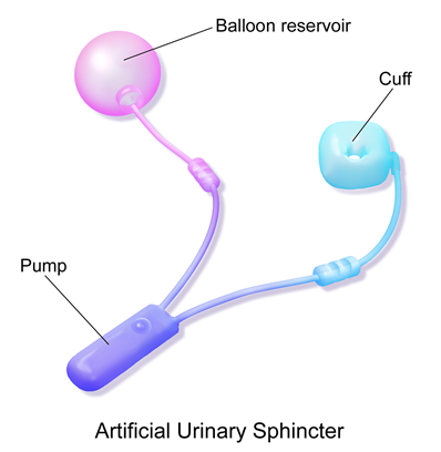 Inkontinencija, arteficijelni sfinkter 2