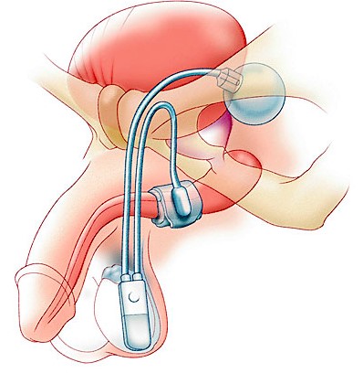Incontinence, artificial sphincter 1