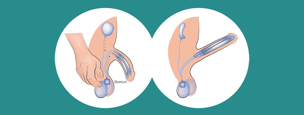Penile prosthesis