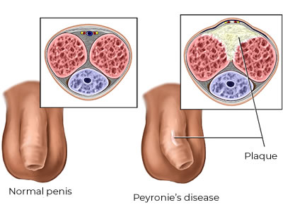 Peyronie's disease