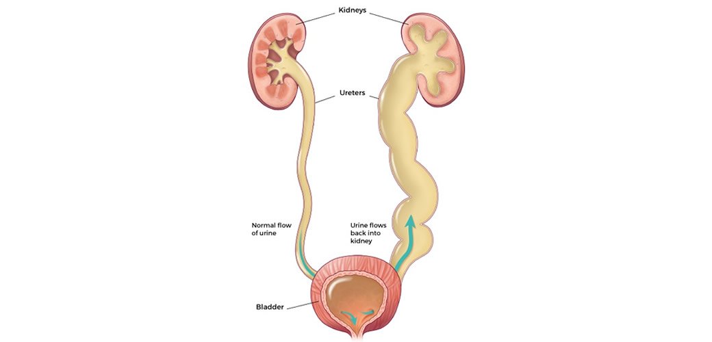 VESICOURETERAL REFLUX (VUR) IN CHILDREN