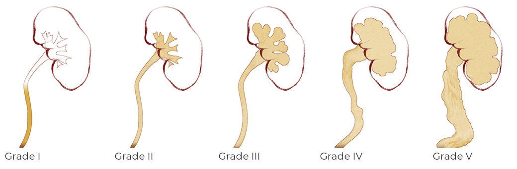 VESICOURETERAL REFLUX (VUR) IN CHILDREN GRADE