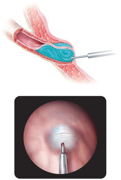 Endoscopic intervention look-VUR