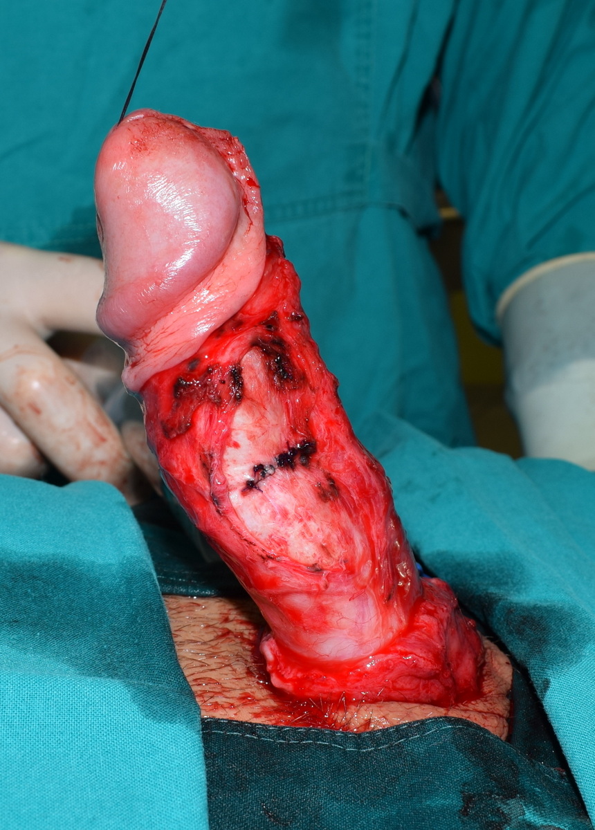 Korekcija deformiteta plikacijom omotača penisa
