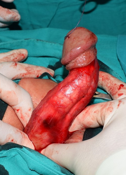 Korekcija deformiteta i erektilne disfunkcije penilnom protezom na naduvavanje