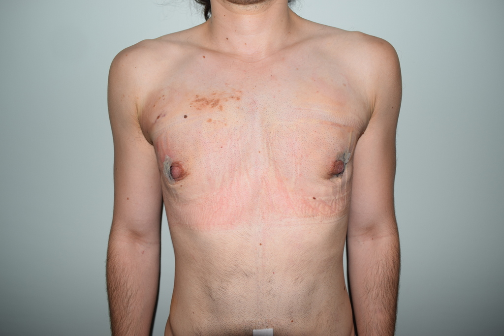 Mastektomija Transrodne osobe