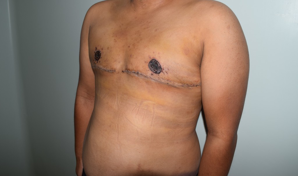 Mastektomija Transrodne osobe