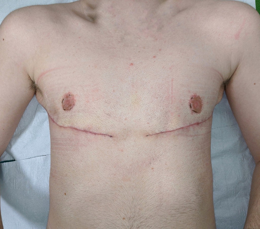 Mastektomija Transrodne osobe