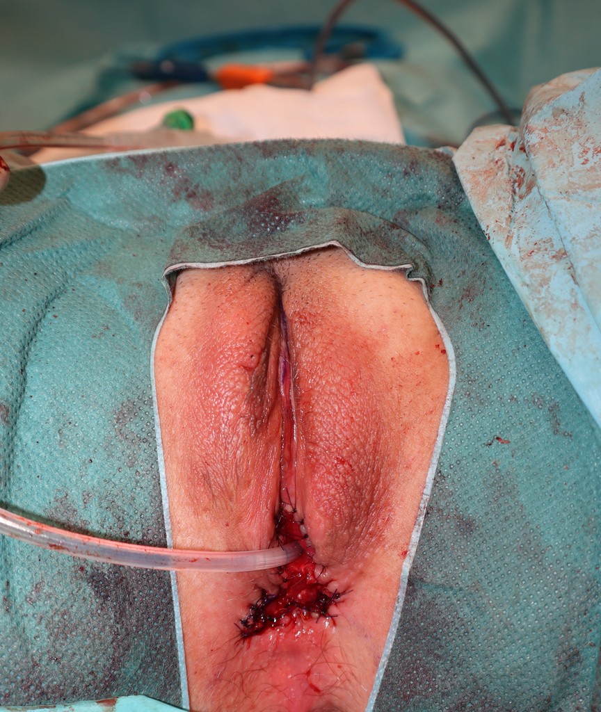 Vaginoplastika Transrodne osobe