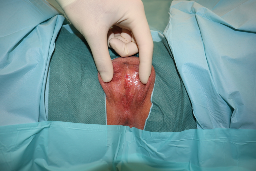 Vaginoplastika Transrodne osobe