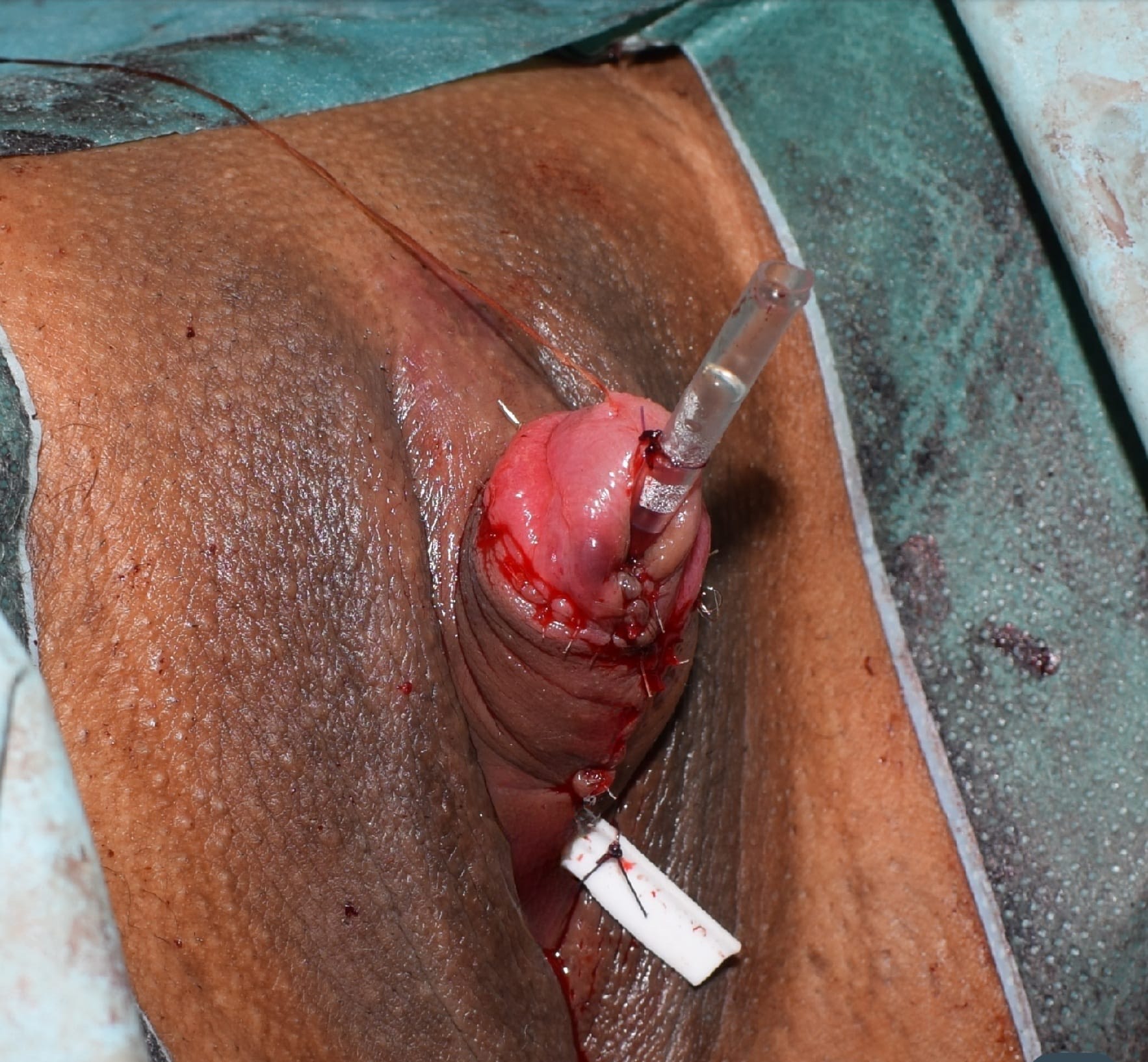 Metoidioplastika Transrodne osobe