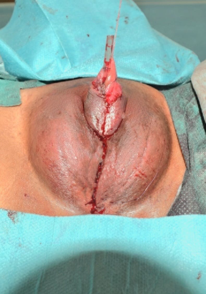 Metoidioplastika Transrodne osobe