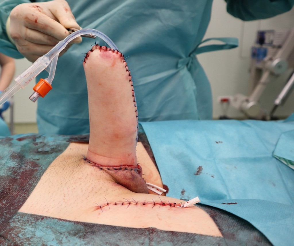 Faloplastika Transrodne osobe