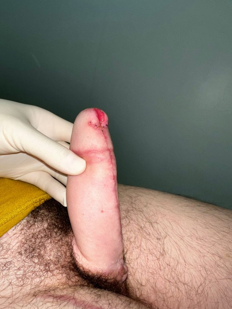 Faloplastika Transrodne osobe