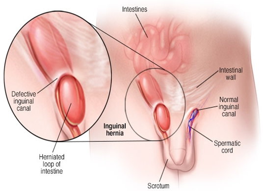 General Surgery Inguinal Hernia