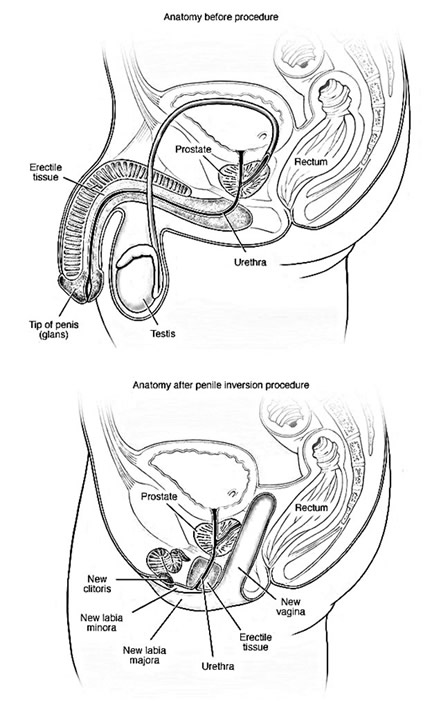 transrodna hirurgija slika 2