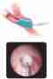 Endoscopic intervention look-VUR