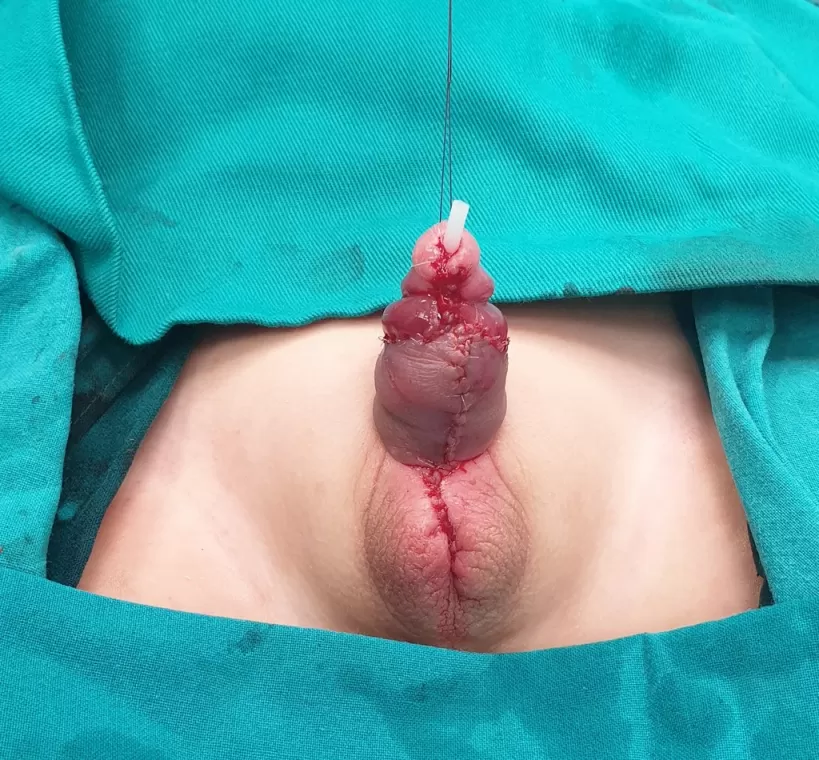 Hipospadija operativne slike - Izgled penisa nakon rekonstrukcije sa donje strane